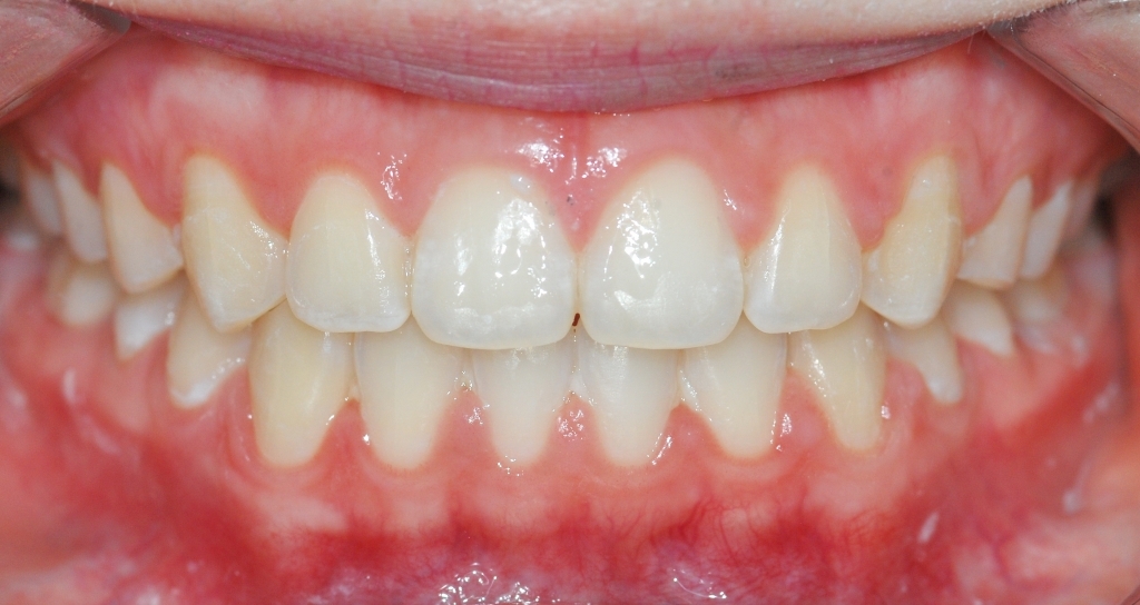 치간이개 치아교정